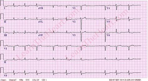 Atrial Fibrillation With Bradycardia Ecg Example 1