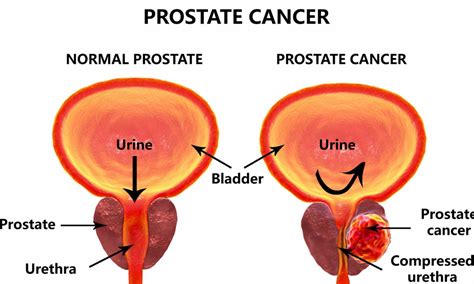 Prostate Function Structure Lobes Benign Enlargement Of Prostate And Malignant Prostatic