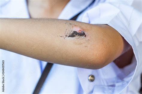 Wound Have Scab On The Elbow Of The Child Stock Photo Adobe Stock