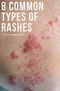 Skin Rash Fungal Infections Fungus - Mayra Flores