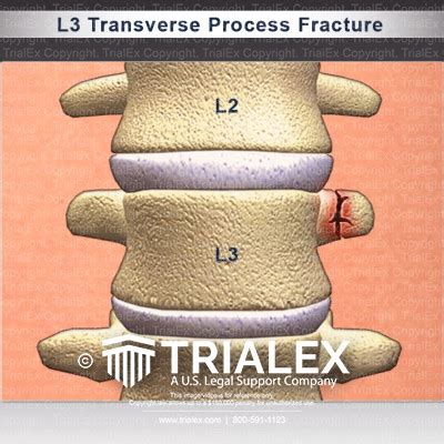 L2 L3 Transverse Process Fracture