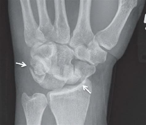 Perilunate Dislocation Radiology Key