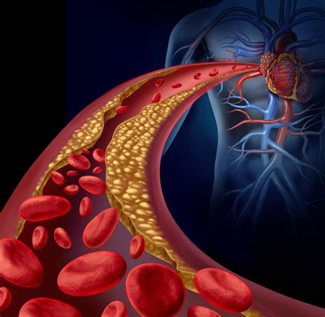 Atherosclerosis Symptoms Risk Factors And Health Complications Cardiology Specialist