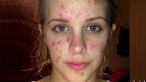 Extreme Acne Retouch Photoshop Makeover Youtube