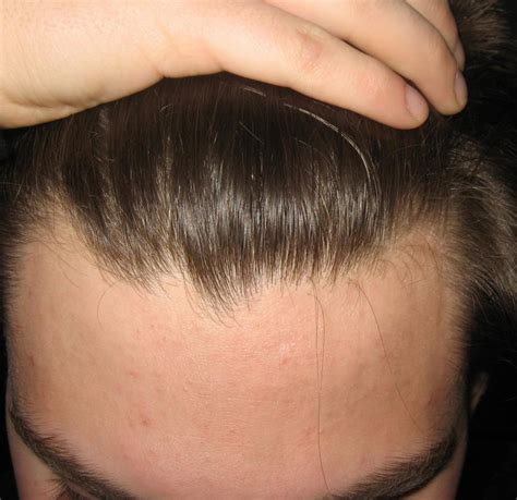 Receding Hairline Stages