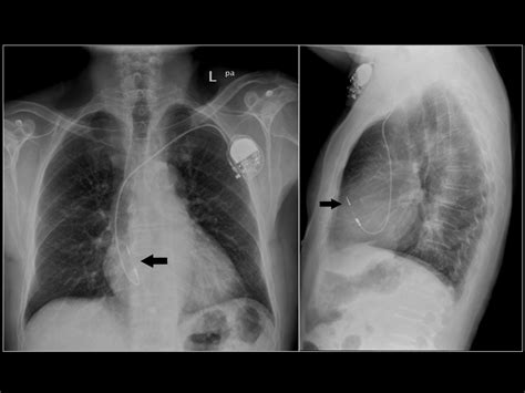 Icd Vs Pacemaker Cxr Imaging Of Implantable Devices Clinical Gate