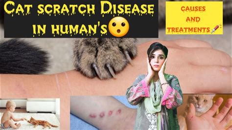 Cat Scratch Disease Csd In Humans Causes Symptoms And Treatment Cat