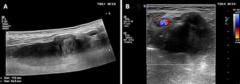 Hematoma Vs Abscess Ultrasound