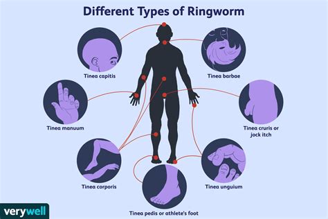 An Overview Of Ringworm 2023