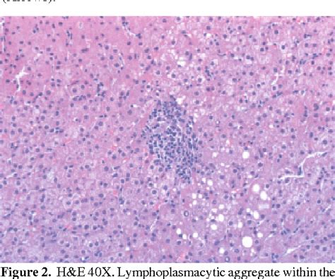 The Liver Biopsy In Viral Hepatitis C Semantic Scholar