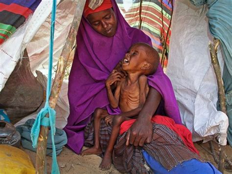 Child Malnutrition Rates Alarming Amid Somalian Drought