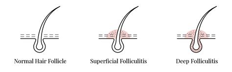 What Is Folliculitis And Whats The Best Way To Treat It