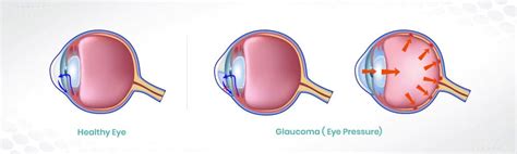 How fast that pressure was reached this afternoon, i saw a patient who woke up with mistiness of vision in his left eye. Glaucoma ( Eye Pressure) - Prof. Dr. Kaan Ünlü