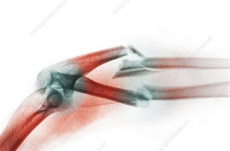 Angulated And Comminuted Fracture Stock Image C0272661 Science