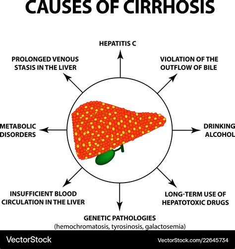Causes Of Cirrhosis Infographics Royalty Free Vector Image