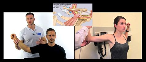 Thoracic Outlet Syndrome Tos Stroke Manual