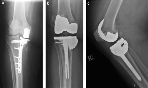 Acetabular Wedge Augments For Uncontained Tibial Plateau Defects In