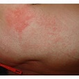 Morbilliform rash: maculopapular exanthem on the trunk. | Download ...