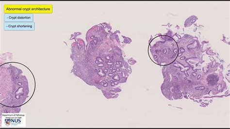 Ulcerative Colitis Microscopy Talking Slide Youtube