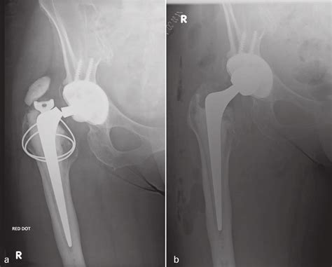 Anteroposterior Radiographs Of Right Hip With An Example Of A Neck