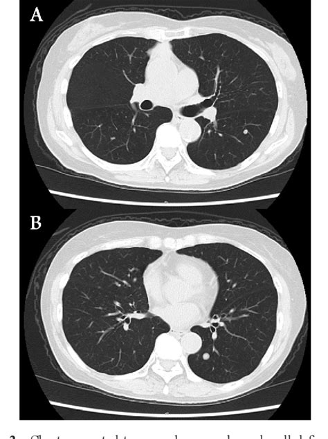 Figure 2 From A Case Of Type A Thymoma With Multiple Lung Metastasis