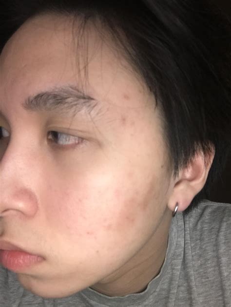 Routine Help Red Patches On Face Around Cheeks And Temple