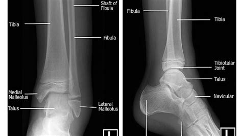 Age Estimation From Ankle X Ray Youtube