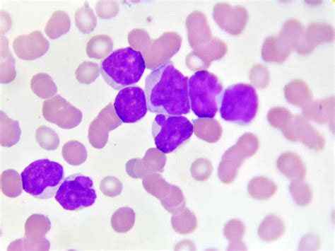How Acute Myeloid Leukemia Is Diagnosed