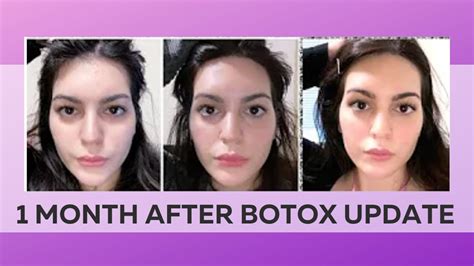 Botox Brow Lift Update This Is What Happens After Botox Youtube