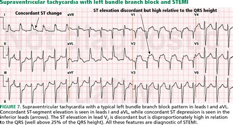 Figure 7 From ST Segment Elevation Differential Diagnosis Caveats