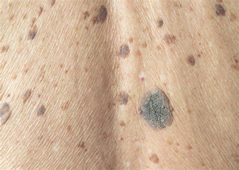 What Is A Seborrhoeic Keratosis Dr Maksym Breslavets