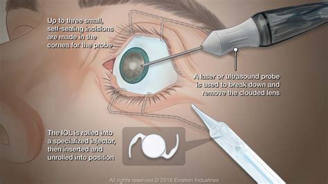 Cataracts St Louis Mo Cataract Surgery Cohen Eye Associates Limited