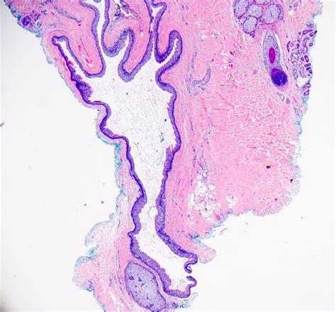 Pathology Outlines Steatocystoma