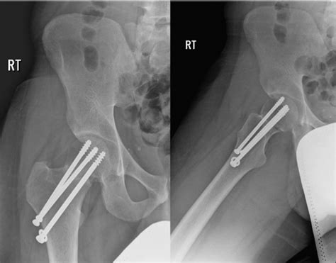 Cureus Completely Displaced Femoral Neck Stress Fracture In A Young