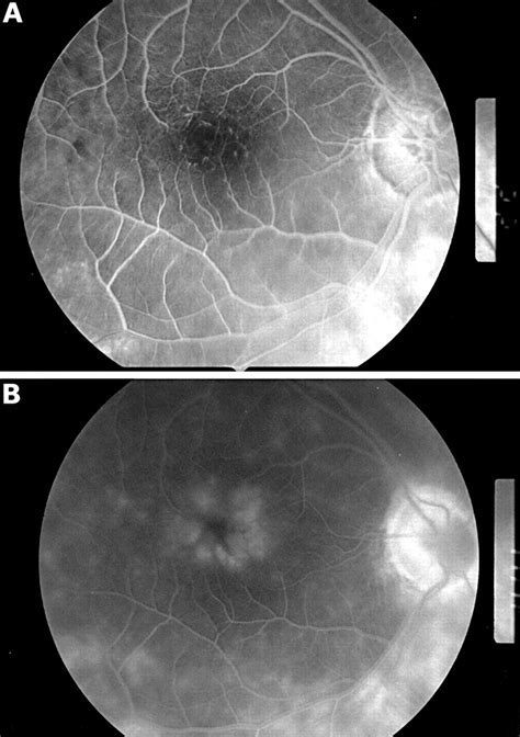 Outcome Of Cataract Surgery In Patients With Retinitis Pigmentosa