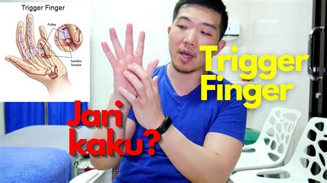 trigger finger and jari kaku 🖐🏻 sembuhin sendiri dengan cara mudah youtube