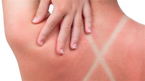 6 Natural Solutions To Help Heal A Sunburn Quickly