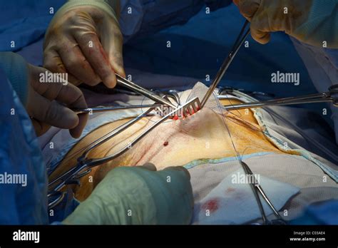 Hernia High Resolution Stock Photography And Images Alamy