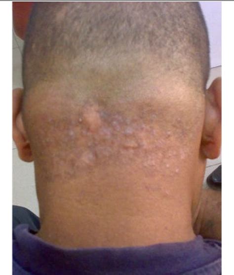 Kurzatmigkeit Erneut einfügen Geizhals acne keloidalis nuchae laser