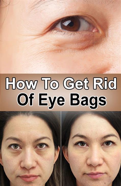 How To Get Rid Of Eye Bags Eye Bags Puffy Bags Under Eyes Diy Eye Bags