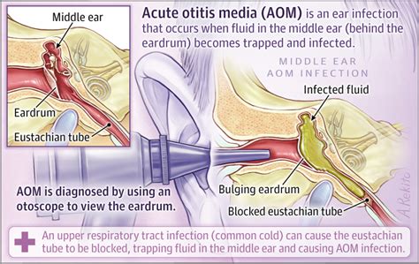 Acute Otitis Media Infectious Diseases Jama Pediatrics Jama Network