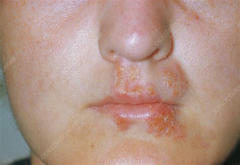 Herpes Simplex Sores On Lip And Mouth Stock Image M1700089 Science