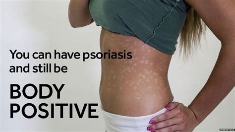 Facts Psoriasis Sufferers Want To Share With You Bbc News
