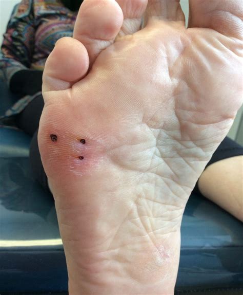 Plantar warts might be one of the more frustrating types of warts, however, since they appear on the feet. Plantar Warts - Ottawa Foot Clinic