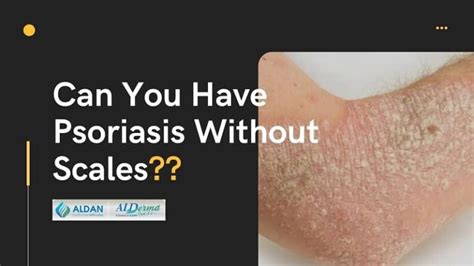 Is Psoriasis Contagious Archives Aldan Healthcare Healthcare With Care