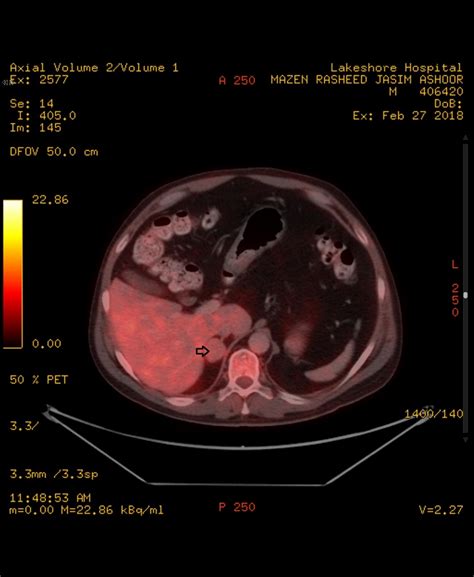 A Case Report Of Cortisol Secreating Adrenal Adenoma Causing Cushing
