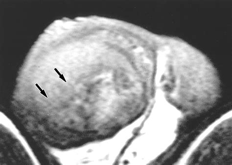 Sonographic And Mr Imaging Findings Of Testicular Epidermoid Cysts Ajr