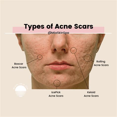 Types Of Acne Scars Pictures Diagnosis And Treatments