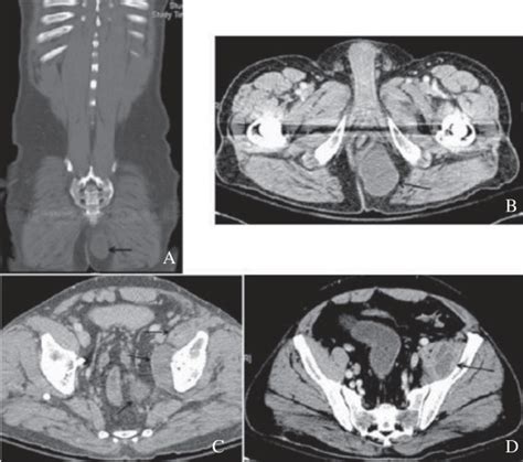 Magnetic Resonance Imaging Of The Pelvis Demonstrated Large Complex
