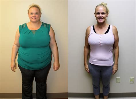 Gastric Sleeve Before And After In St Louis St Louis Bariatrics